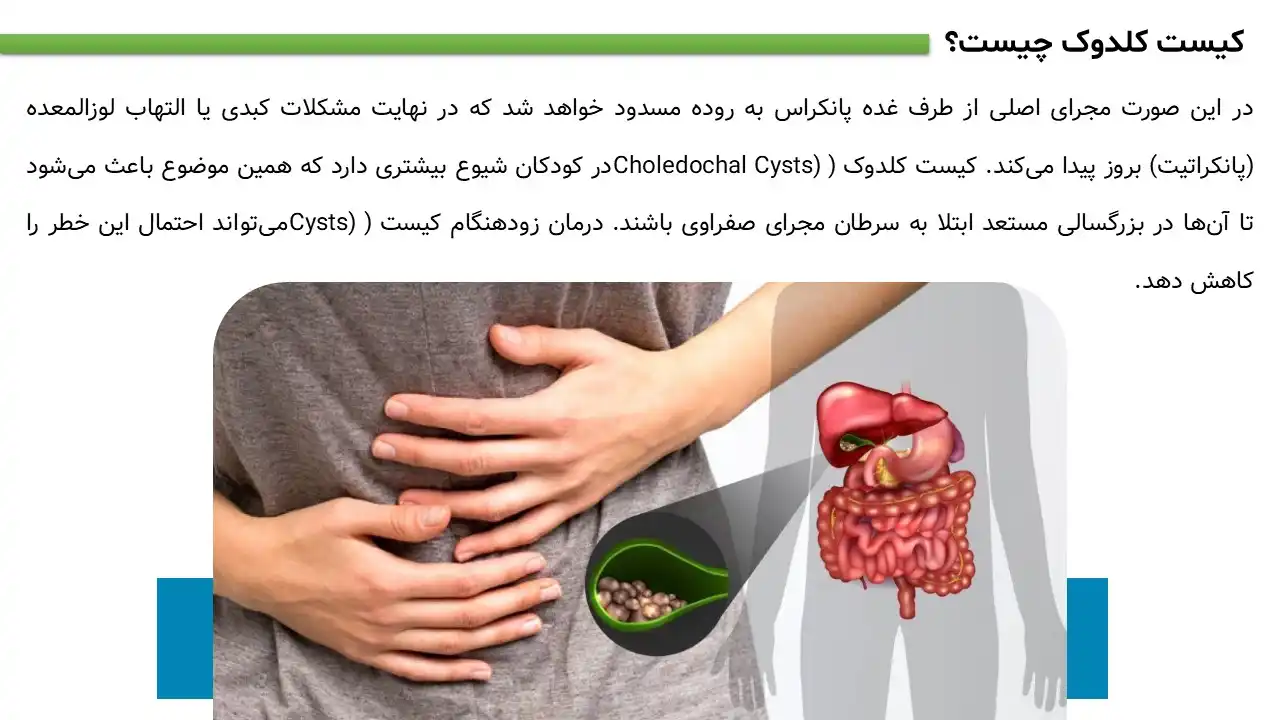پاورپوینت کیست کلدوک