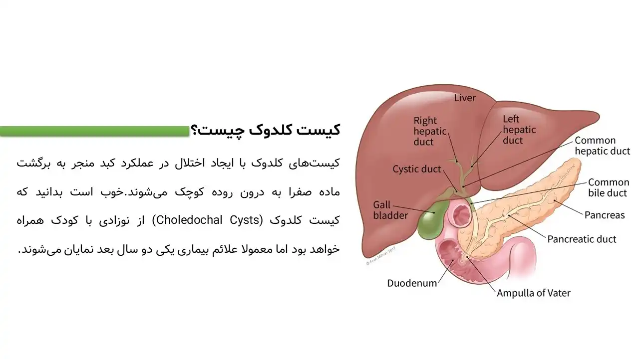 پاورپوینت کیست کلدوک