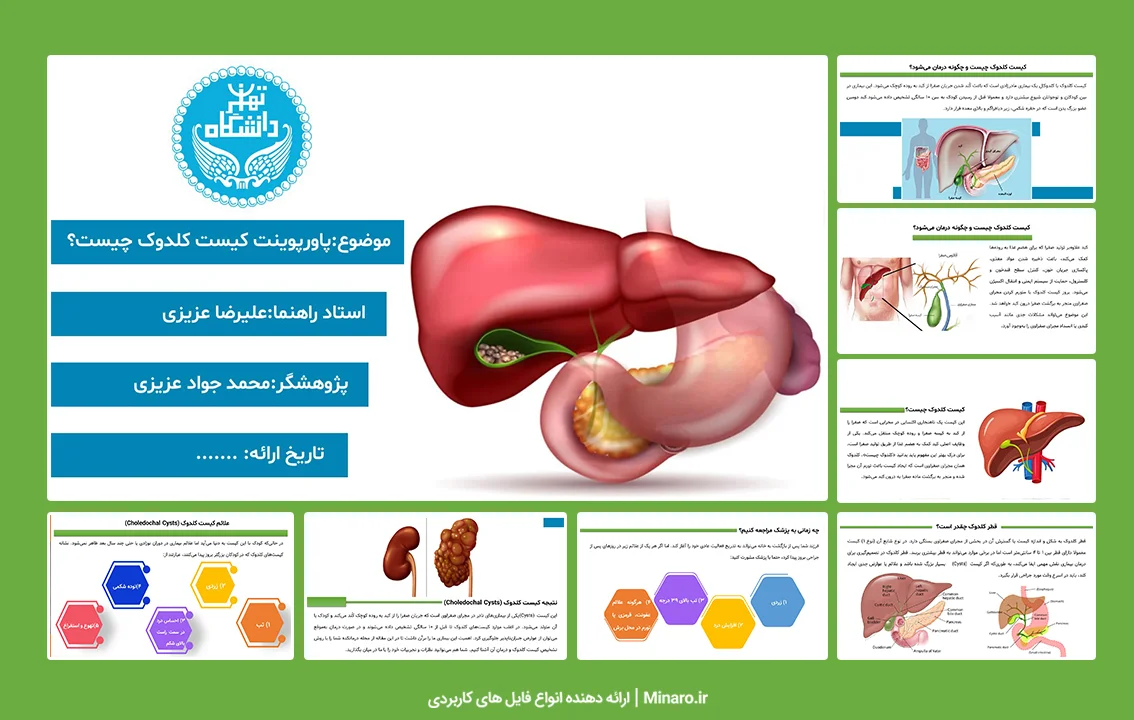 پاورپوینت کیست کلدوک