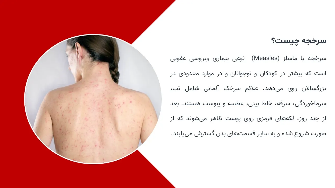 پاورپوینت سرخک