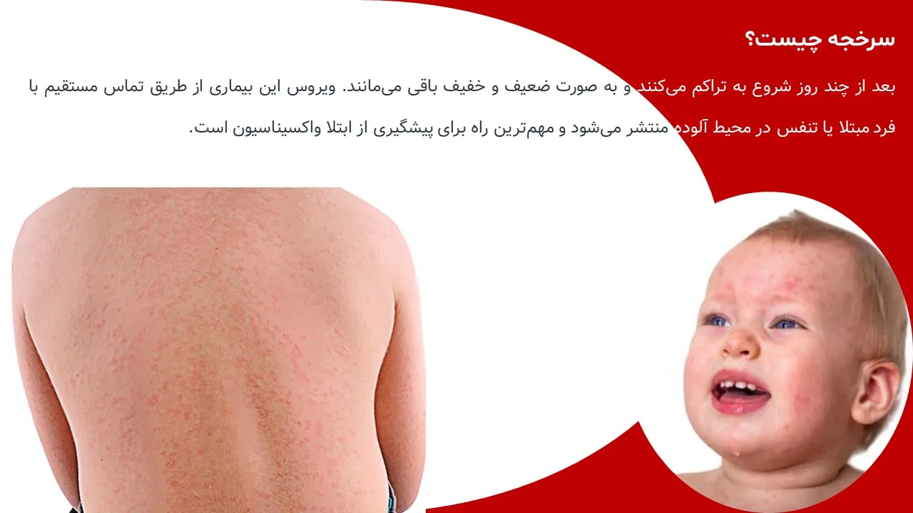 پاورپوینت سرخک