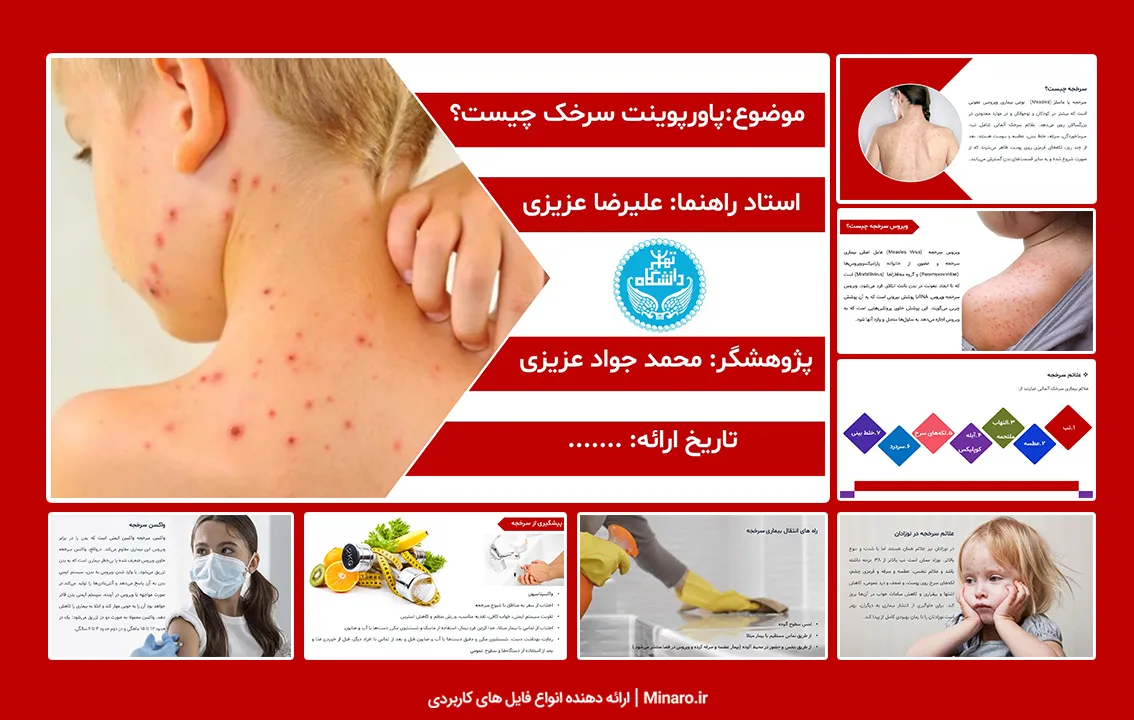 پاورپوینت سرخک