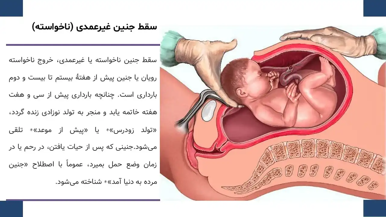 پاورپوینت سقط جنین