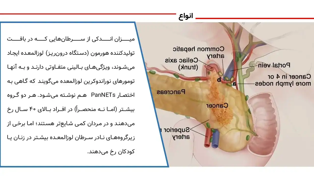 پاورپوینت سرطان پانکراس