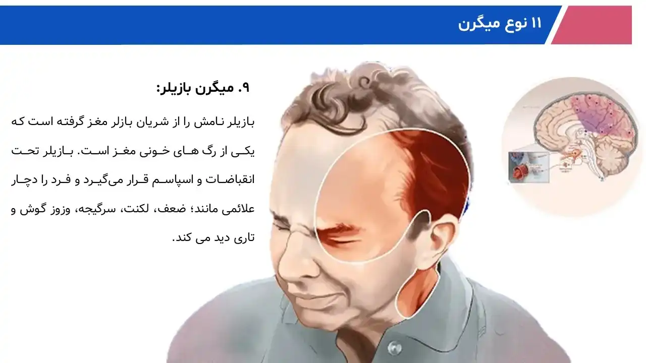 پاورپوینت میگرن