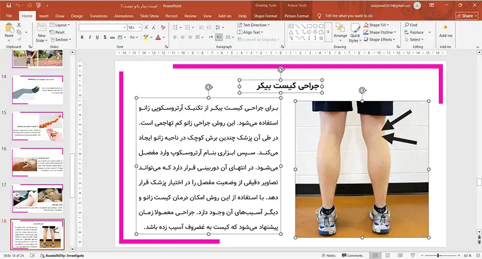 کیست بیکر زانو چیست؟