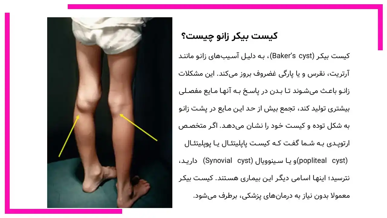 کیست بیکر زانو چیست؟