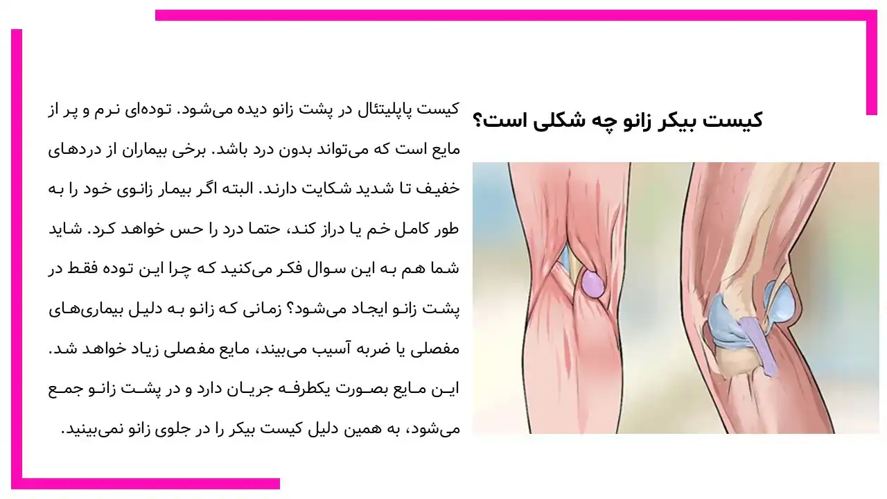 کیست بیکر زانو چیست؟