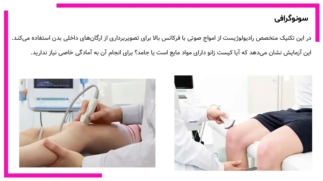 کیست بیکر زانو چیست؟