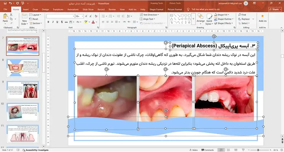 پاورپوینت آبسه دندان