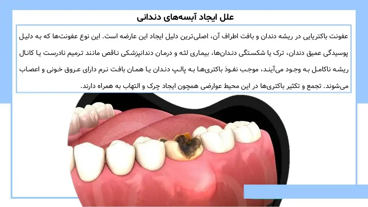 پاورپوینت آبسه دندان