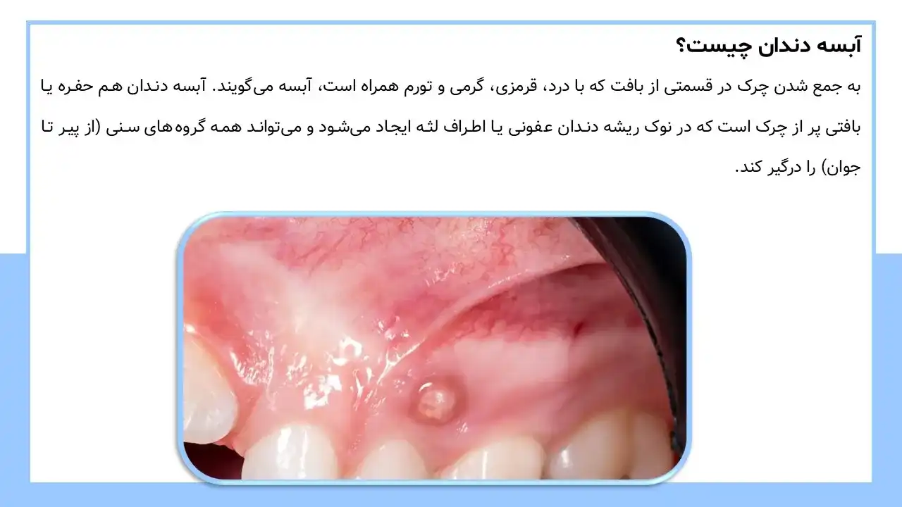 پاورپوینت آبسه دندان