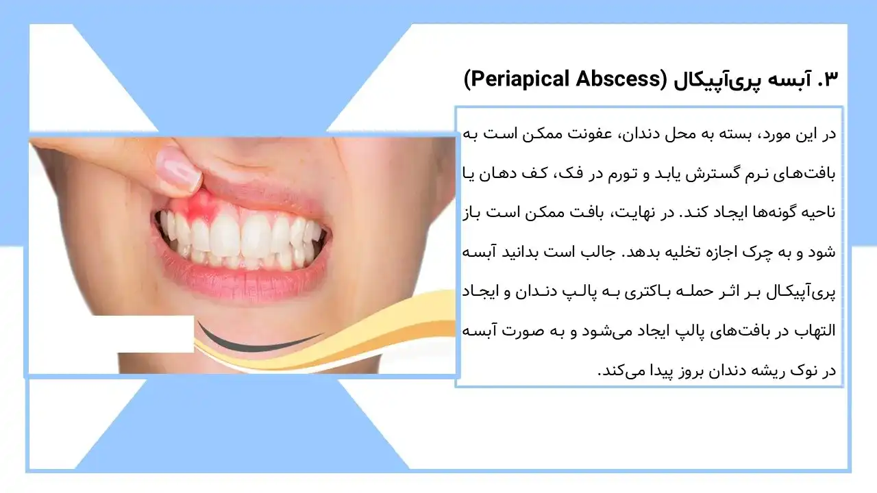 پاورپوینت آبسه دندان