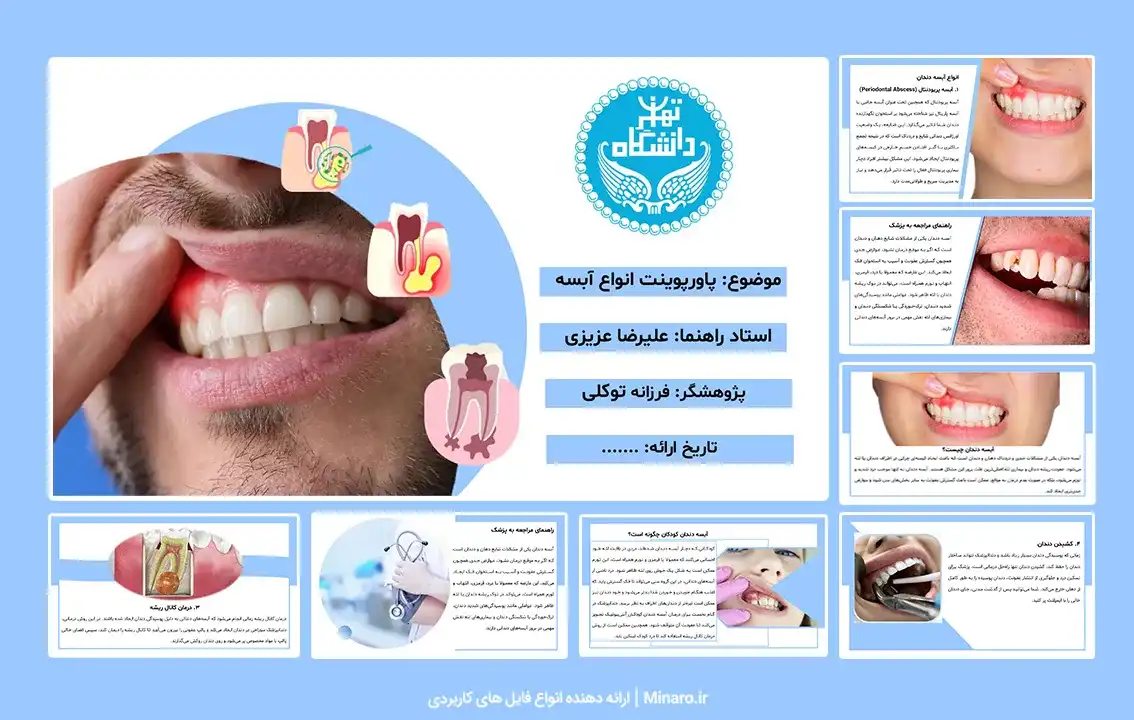 پاورپوینت آبسه دندان