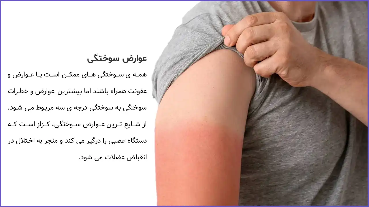 پاورپوینت سوختگی و اقدامات پرستاری