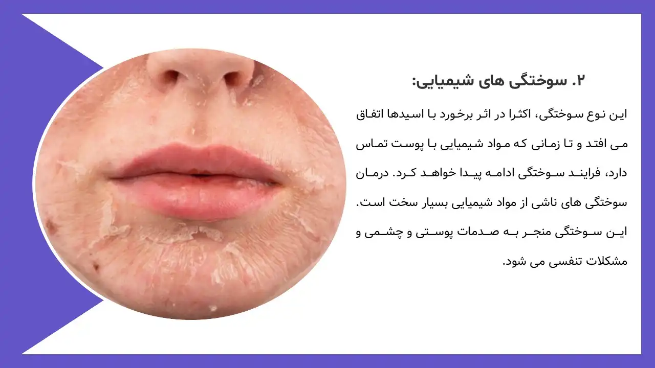 پاورپوینت سوختگی و اقدامات پرستاری