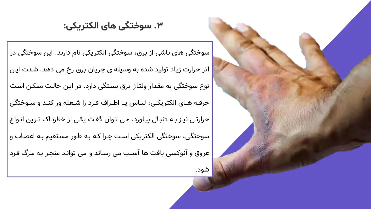 پاورپوینت سوختگی و اقدامات پرستاری