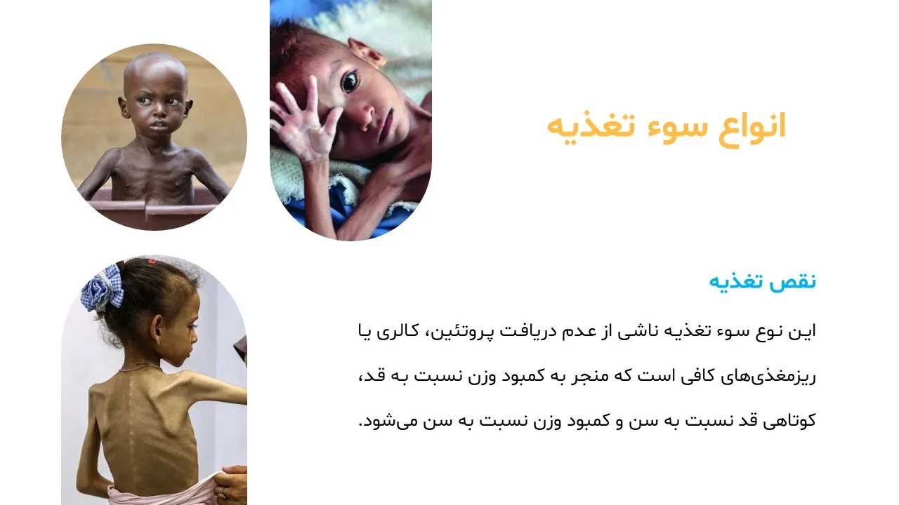 پاورپوینت سوء تغذیه
