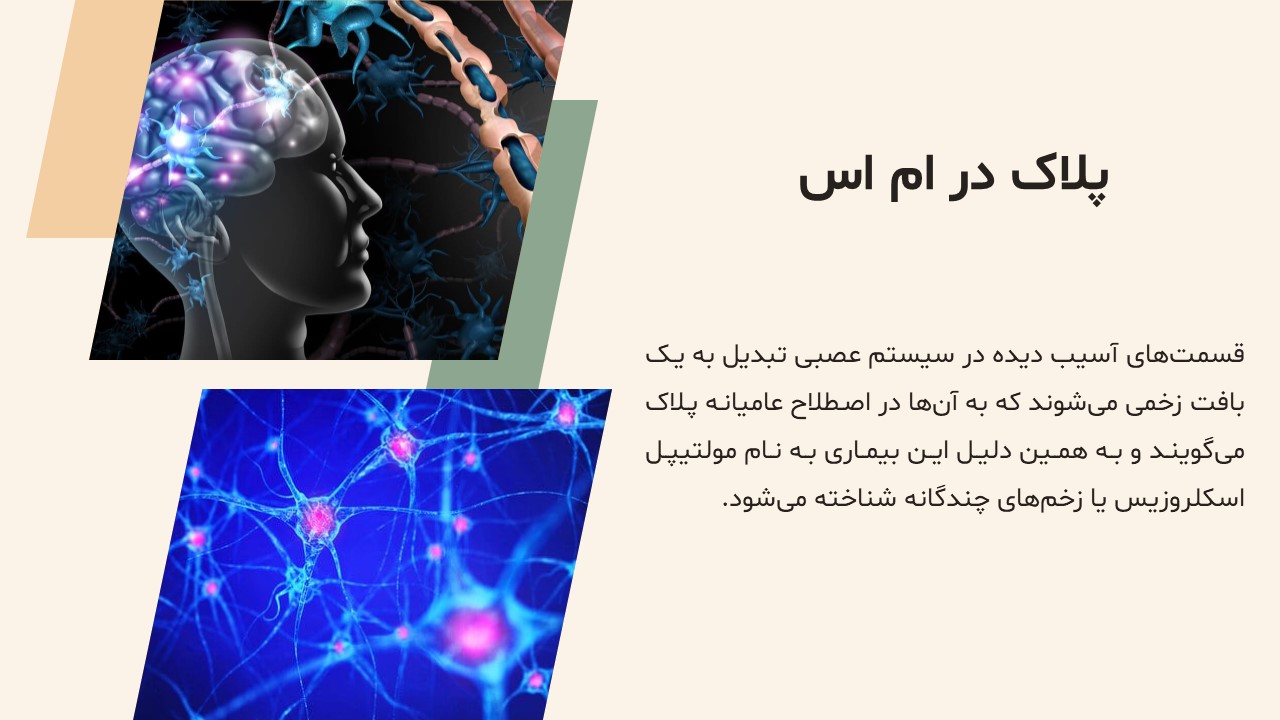 Slide5 پاورپوینت بیماری ام اس
