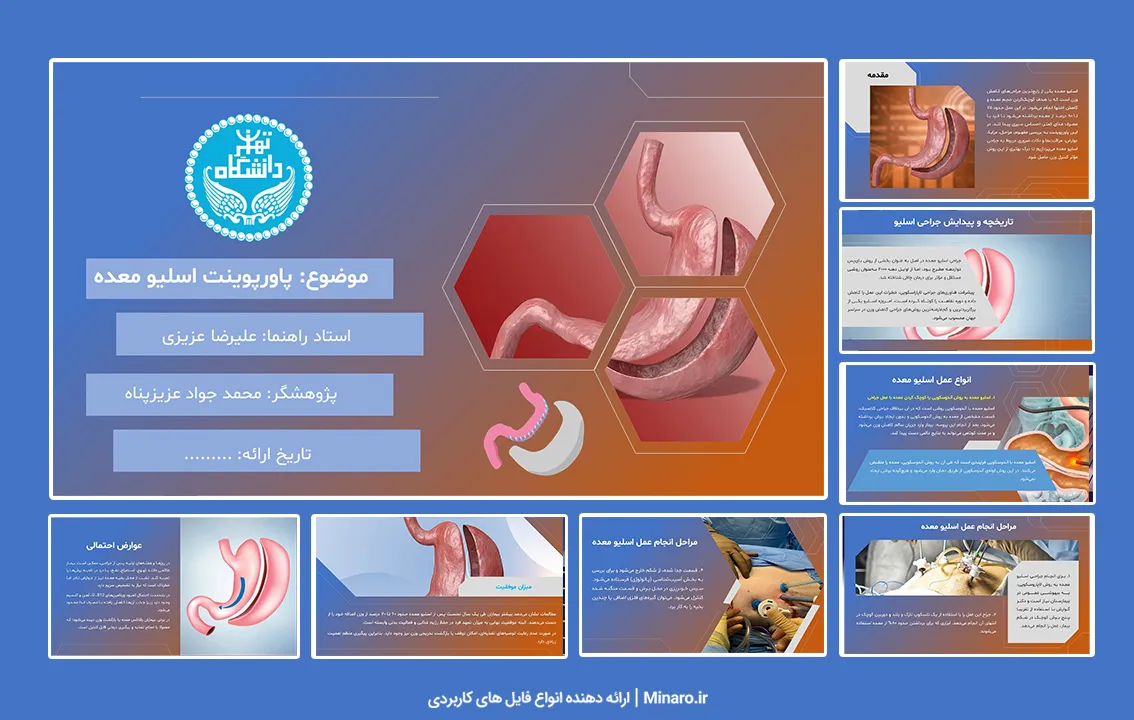 پاورپوینت اسلیو معده